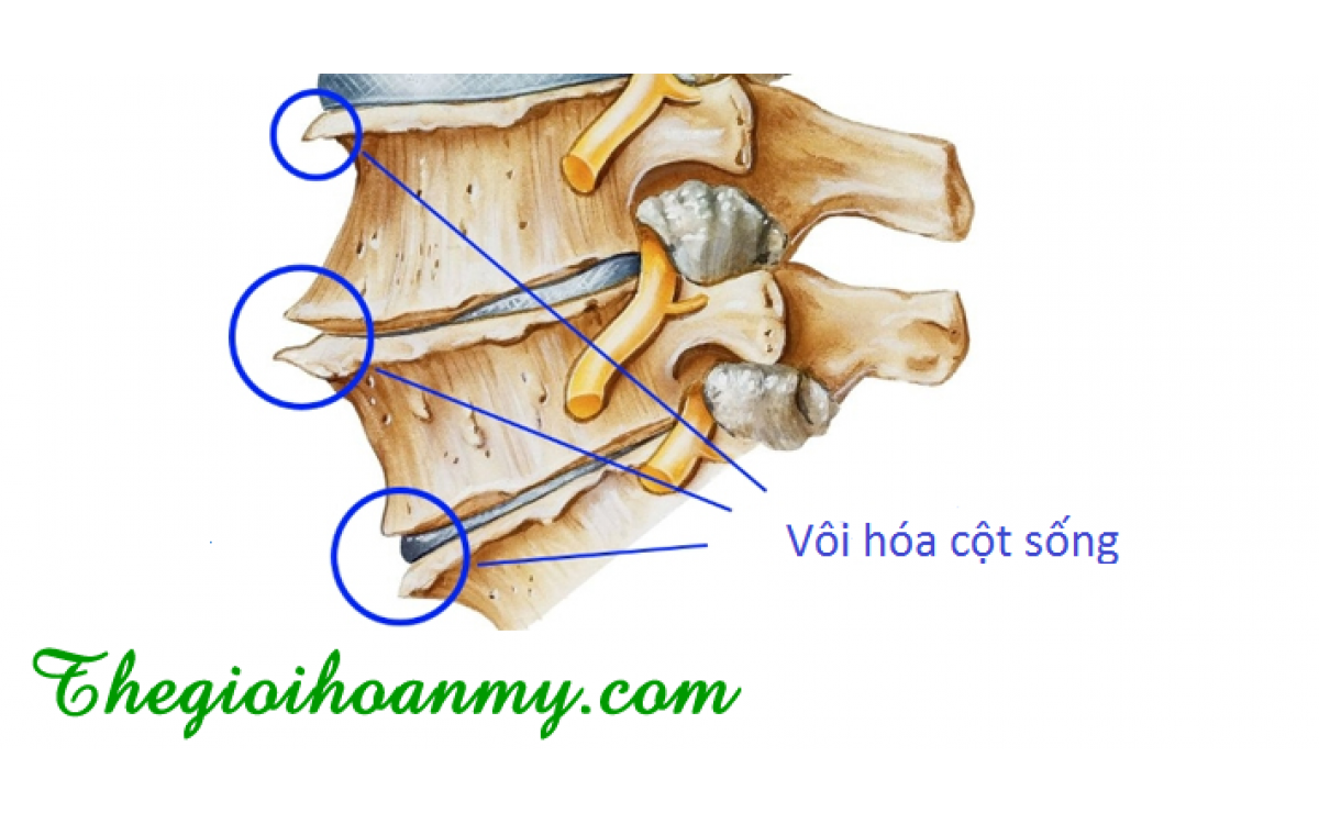 Các nguyên nhân gây vôi hóa cột sống cần biết: